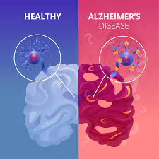 Comparison of a healthy brain and a brain affected by Alzheimers Disease.