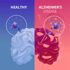 Comparison of a healthy brain and a brain affected by Alzheimer's Disease.